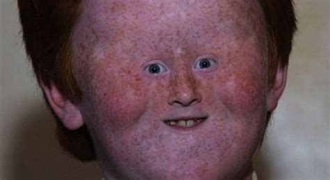 Gingers Set To Die Out Due To Increasingly Sunny Skies In Scotland
