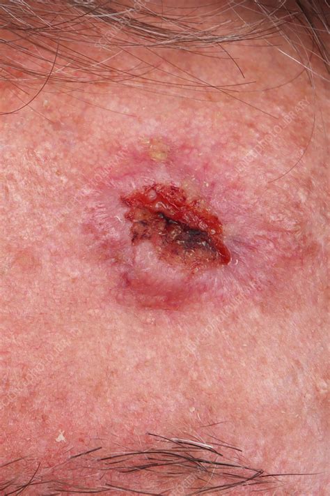 Squamous Cell Carcinoma Stock Image C0590707 Science Photo Library