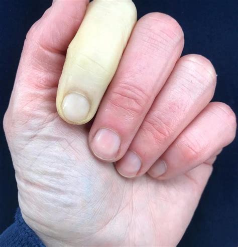 What Is Raynauds Disease What Are The Signs And Symptoms Of Jenni