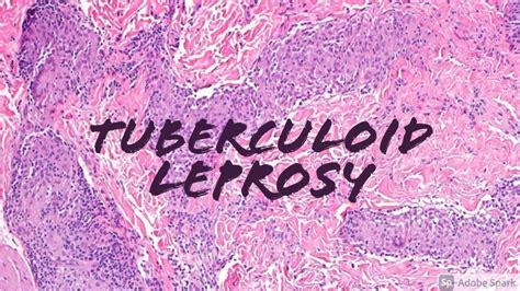 Tuberculoid Leprosy Hansen Disease 5 Minute Pathology Pearls