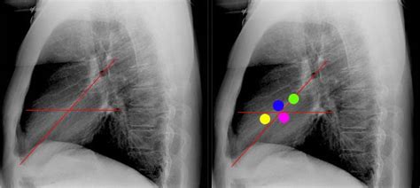 Cardiac Valves Chest X Ray