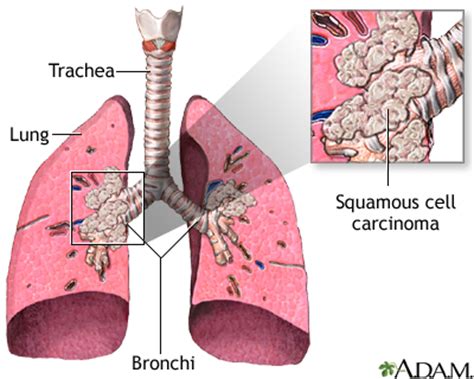 Squamous Cell Carcinoma MedlinePlus Medical Encyclopedia Image