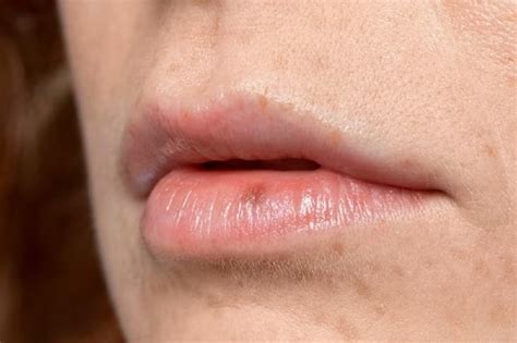 Lip Discoloration What It Means Causes And Treatments