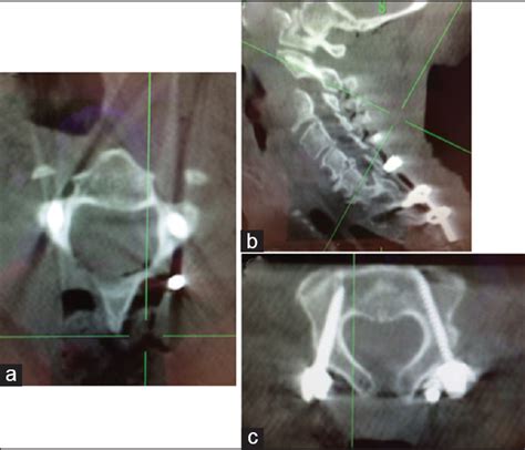 Axial And Oblique C2 Pedicle Diameters And Feasibility Of C2 Pedicle