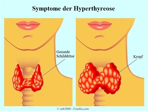 Check spelling or type a new query. Hyperthyreose, Symptome, Schilddrüse, TSH, Ursachen ...