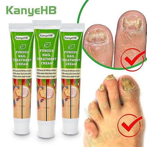 Pcs Nail Fungus Removal Cream Onychomycosis Fungal Nail Treatment