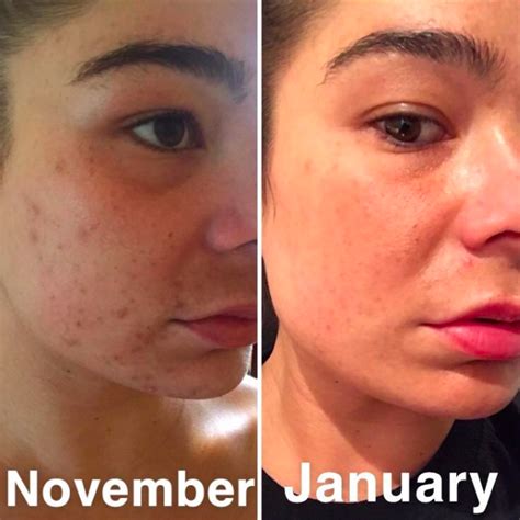 There are a lot of factors and. 24 Products To Help You Deal With Acne Scars