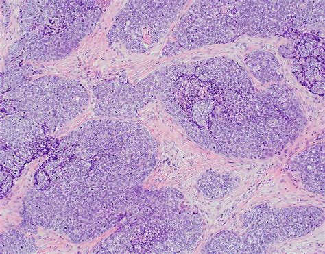 Pathology Outlines Sebaceous Carcinoma