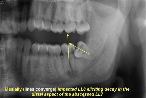 Wisdom Tooth Impaction Classification