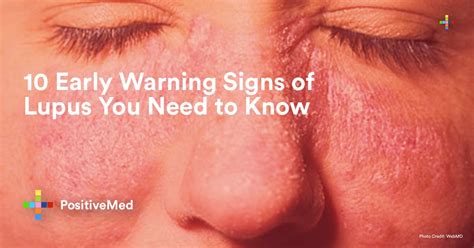 Early Warning Signs Of Lupus You Need To Know