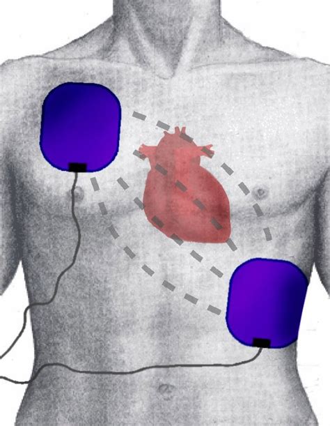 What are capacitors and why we need to use them in defibrillators. Defibrillator. Causes, symptoms, treatment Defibrillator