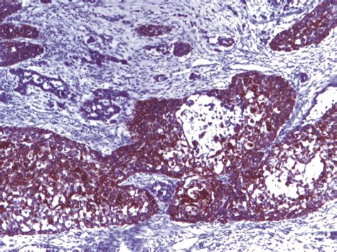 Acantholytic Squamous Cell Carcinoma P53 Positive 40× Download