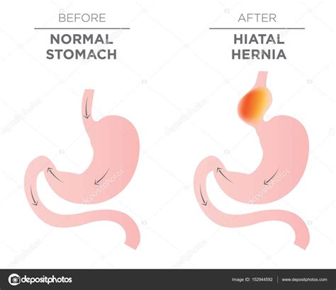 Hiatus Hernia Stomach Image Stock Vector Image By ©bearsky23