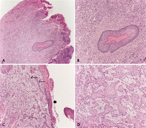 Squamous Cell Carcinoma Arising In An Odontogenic Keratocyst A