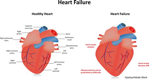 Incident Heart Failure Its Not Just Lvef Anymore Physicians Weekly