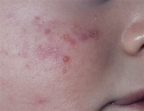 Baby Rashes Pictures Causes Treatment