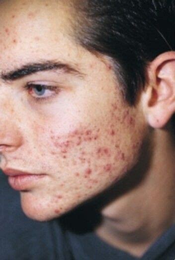 Pretty Boy Face Acne Skin Acne Men