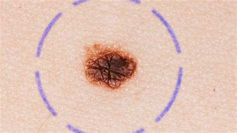 Skin Cancer Check Number Of Moles On Your Right Arm An Indicator Of Risk Experts Say