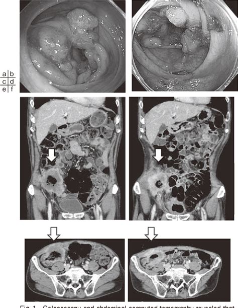 figure 1 from laparoscopy assisted ileocecal resection for cecal cancer with invasion of the