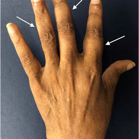 Left Hand Soft Tissue Swelling Nodules Of The Middle And Proximal