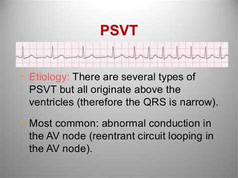 Supraventricular tachycardia (svt, psvt) is one type of heart rhythm disorder in which the heart beats faster than normal. ECG from Alpha to Omega