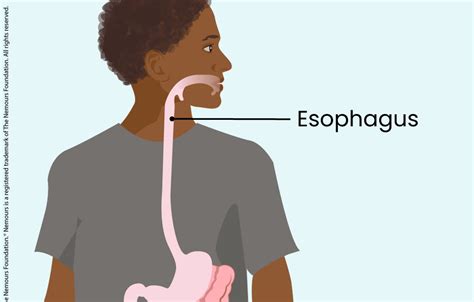 Eosinophilic Esophagitis Eoe
