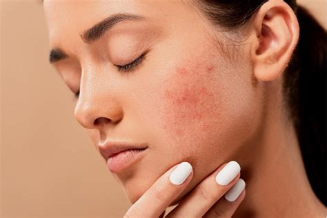 Ultimate Guide To Getting Rid Of Fungal Acne Find That Glow