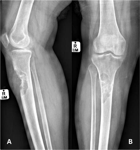 a lateral and b anteroposterior radiographs of proximal right tibia download scientific