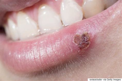 Cold Sores Is There A Way To Cure The Curse Ive Tried Everything Huffpost Uk