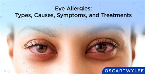 Eye Allergies Types Causes Symptoms And Treatments