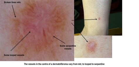 Dermoscopy Made Simple Dermatofibroma