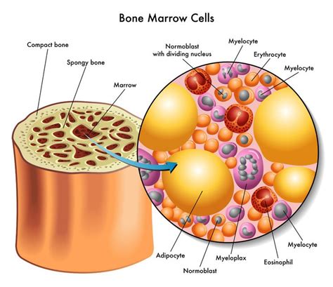 It contains stem cells that produce blood cells and other cell types. How Multiple Myeloma of the Spine Is Diagnosed