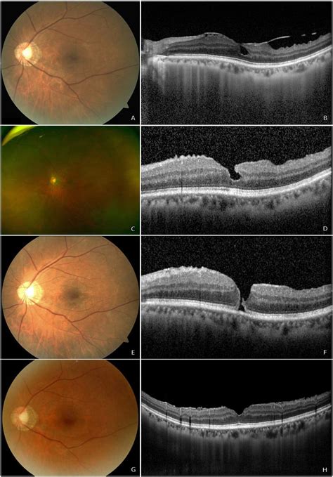 A 65 Year Old Woman Underwent Vitrectomy With Internal Limiting