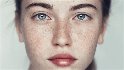 How To Get Rid Of Freckles 15 Top Treatments Home Remedies Fabbon