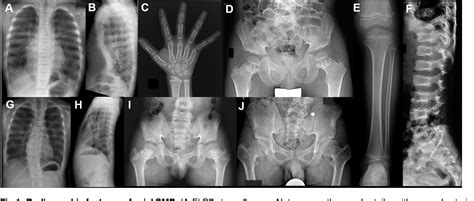 Figure 1 From Axial Spondylometaphyseal Dysplasia Is Caused By C21orf2