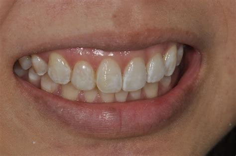 Case 3 Aesthetic Fillings With Resin Composite Prestige Dental Care