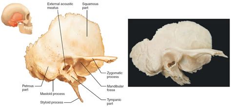 Temporal Bone Anatomy Parts Of Temporal Bone Temporal Bone Fracture
