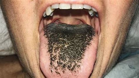 Qué es el hongo negro y por qué se produce. Las cinco cosas que tu lengua te puede estar diciendo ...