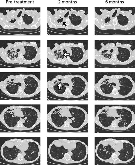 Chest Ct Scans During Therapy Non Contrast High Resolution Chest Ct