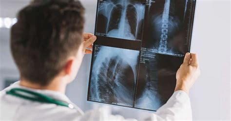 Radiografia O Que é Raio X E Como Funciona O Exame