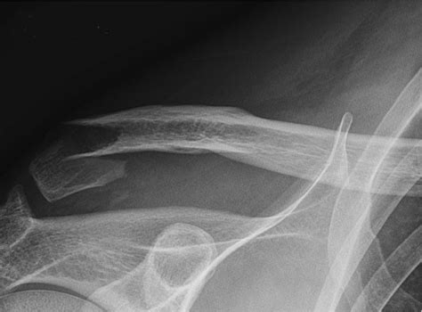 Plain Ap X Ray Of A Displaced Right Distal Clavicle Fracture Neer Type
