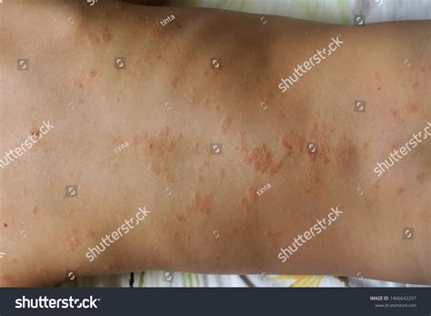 Dermatological Skin Disease Atopic Dermatitis Symptom Stock Photo Edit