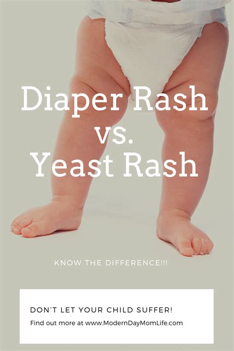 How Widespread Is Yeast Diaper Rash New Ternds