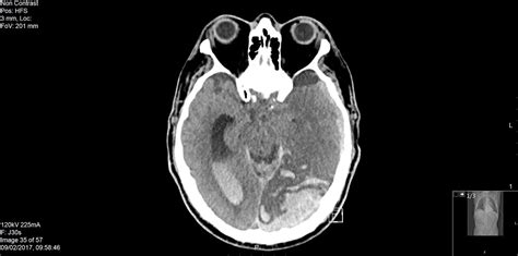 Spontaneous Intracerebral Haemorrhage A Rare Complication Of Aortic