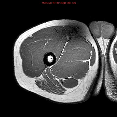 Thigh Muscle Anatomy Mri Figure 2 From Normal Mr Imaging Anatomy Of