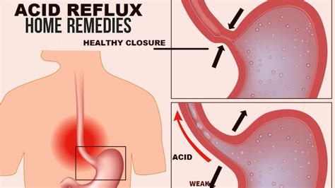 How to deal with burnt throat from hot food it is important to cool down your burned tissue to prevent further damage and you can do it by drinking something cold immediately after burning throat from hot food. 5 Best Home Remedies for Acid Reflux