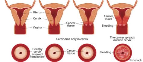 However, the bleeding can have other causes, such as a hormonal. 9 Signs That Might Indicate You Have Cervical Cancer- Don ...