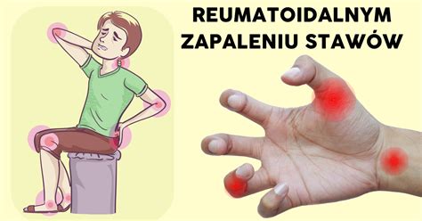 Wszystko Co Trzeba Wiedzie O Reumatoidalnym Zapaleniu Staw W