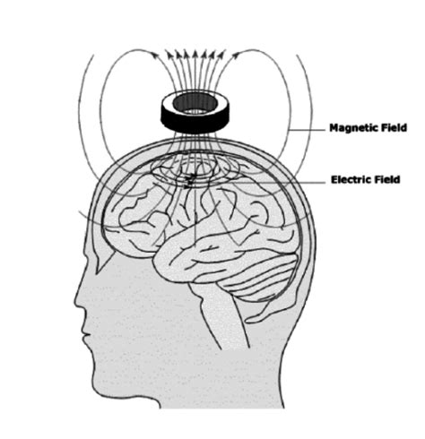 Transcranial Magnetic Stimulation An Impulse Current Flow In The Coil