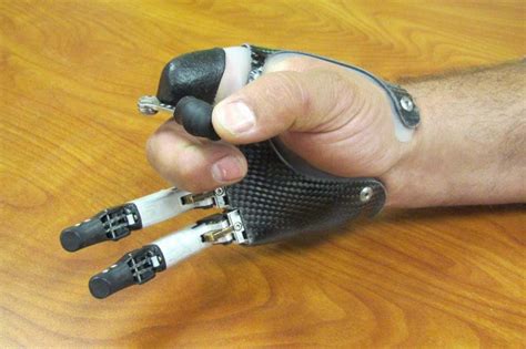 Finger And Partial Hand Prosthetic Options Prosthetics Blog